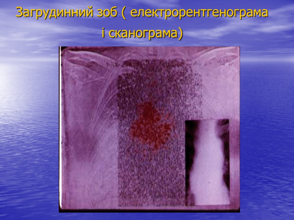 Загрудинний зоб ( електрорентгенограма і сканограма)